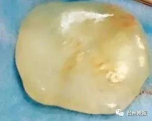 女婴带"玉"出生 医生:这东西全世界都极为罕见