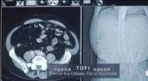 糖吃多了 几个月后身体的惊人变化