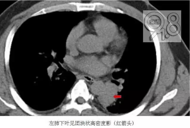 男子咳嗽半月咳出血以为得癌 结果居然是这样
