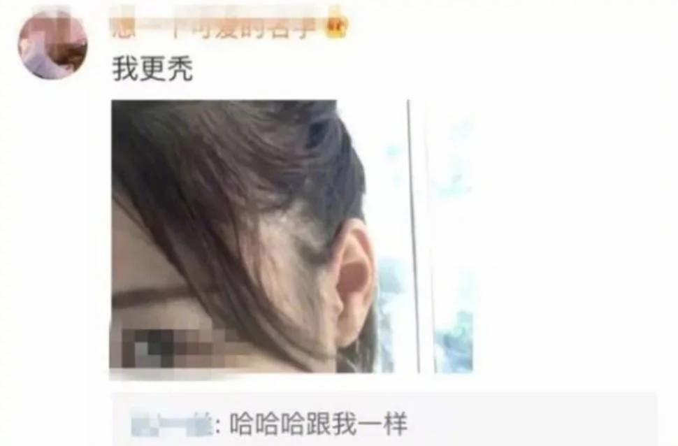 90后集体脱发变秃了…姑娘 请珍惜你的秀发!