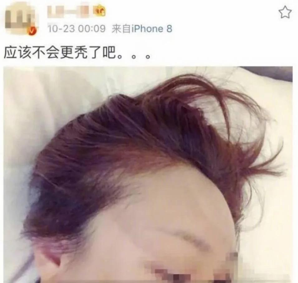 90后集体脱发变秃了…姑娘 请珍惜你的秀发!