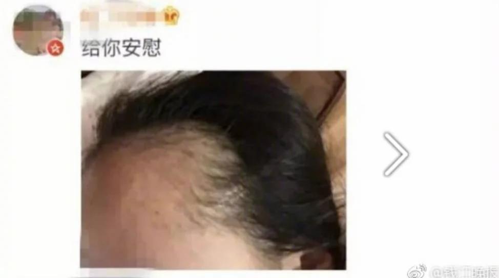 90后集体脱发变秃了…姑娘 请珍惜你的秀发!
