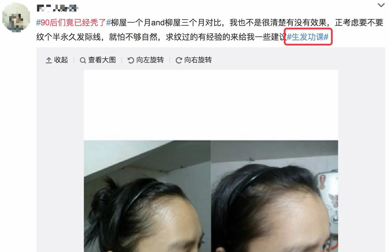 90后集体脱发变秃了…姑娘 请珍惜你的秀发!