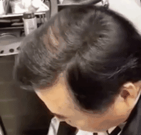 90后集体脱发变秃了…姑娘 请珍惜你的秀发!