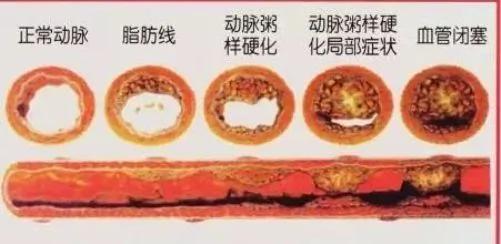 血管就是这么一天一天被堵死的 可惜这个进程多数人都不知道!