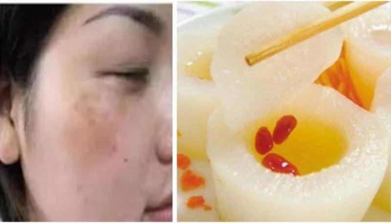 脸上的斑肝被“气”坏了 肝毒没排出 小心肝炎快来看怎么给你的肝解解