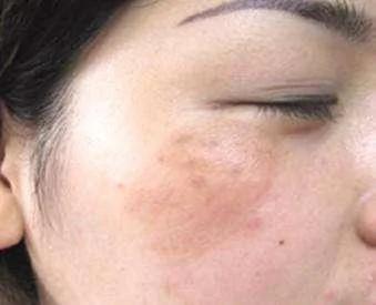 脸上的斑肝被“气”坏了 肝毒没排出 小心肝炎快来看怎么给你的肝解解