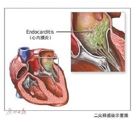 孕妇发烧2个月 心脏成“豆腐”全身血液“有毒”
