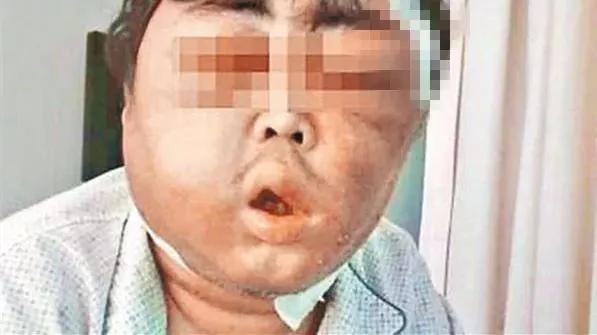 男子吸入二手烟一觉醒来脸成"猪头"还差点丧命
