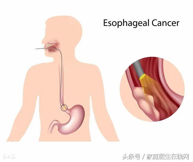 很多人得食道癌 医生说出真相:长期吃这几种食物很致癌
