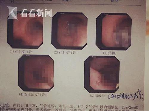 核桃仁惹的祸! 男子吃核桃差点丢命
