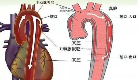 背痛一天 便“骤然离世” 医院的同事措手不及 这病真是凶险!