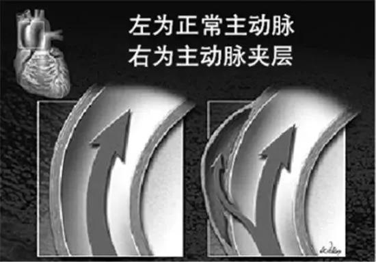 女子腹部剧痛第2天便去世 医生:这种病冬季高发