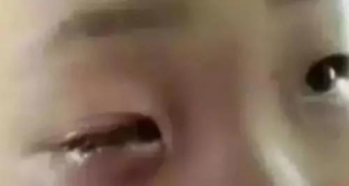 警惕!男童不经意玩这东西 20分钟眼珠被完全溶解