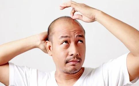 男人脱发原因有哪些 不良药物影响要注意