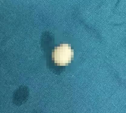 小心这东西!男童鼻头被削掉 母亲捡起就往医院跑