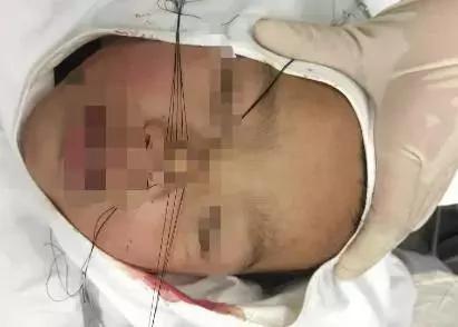 小心这东西!男童鼻头被削掉 母亲捡起就往医院跑