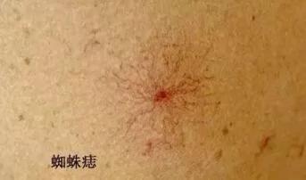 医生:肝脏有“三怕” 两个伤肝坏习惯 需改正!