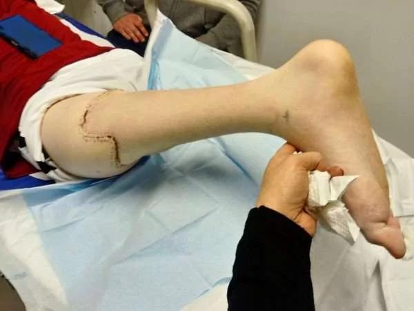 男孩的右腿被截肢 但他不靠拐杖就能快速行走 连自己都吓到了!