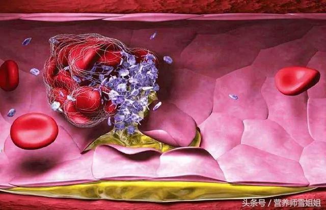 4类人易被血栓“拴住” 2动作“冲洗”血管