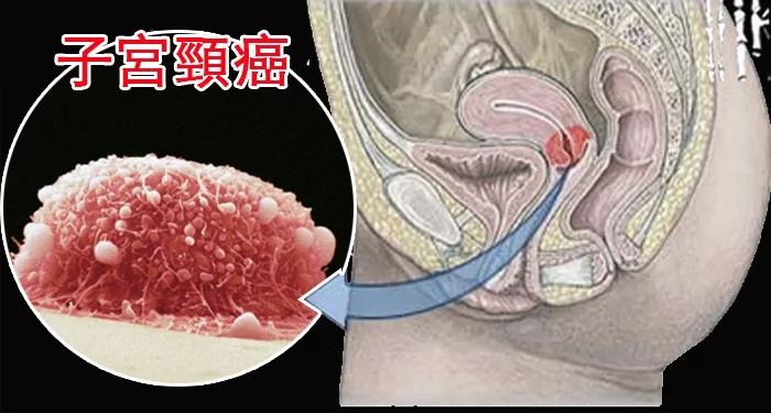 “子宫颈癌”有救了!这个我们“常吃的菜”竟可杀死多它100倍的子宫颈癌细胞!!