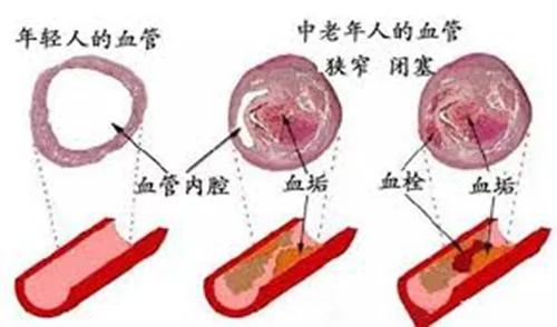 5个坏习惯足以让40岁血管衰老像70岁 但2种食物养好它