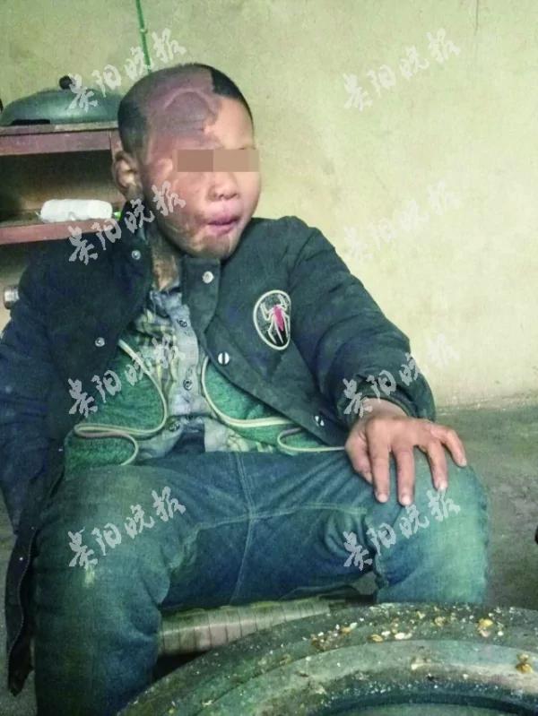 贵州9岁男孩身体半黑半白 黑色部分形同碳素墨水!