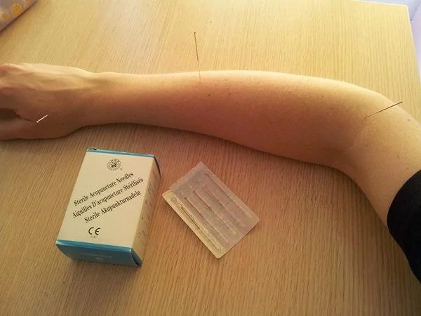 战场针灸:美军用中医针灸戳痛了谁?(反躬自问)