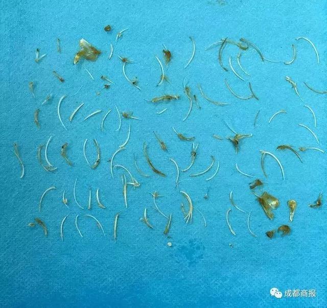 惊呆!60岁大爷喝了两碗鱼汤 体内竟扎上百根鱼刺!