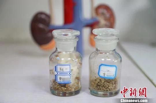 男子体外碎石100余次结石仍疯长 或因长期饮浓茶