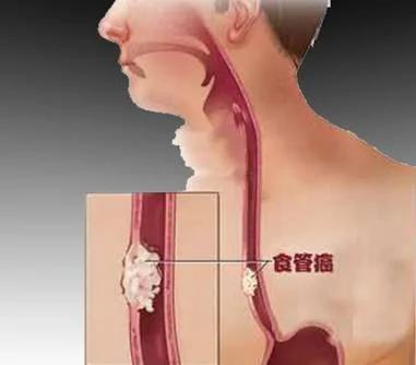 19种癌症的最早信号 提前知道能救命!