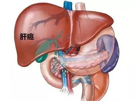 19种癌症的最早信号 提前知道能救命!