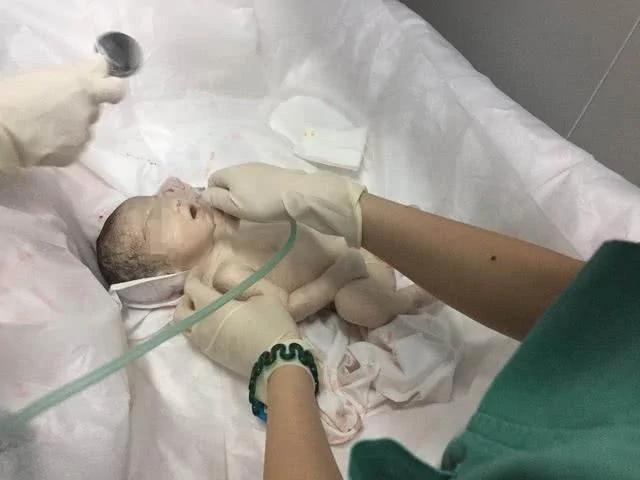 好险!女婴九成血液都给妈妈 一出生秒变"雪公主"