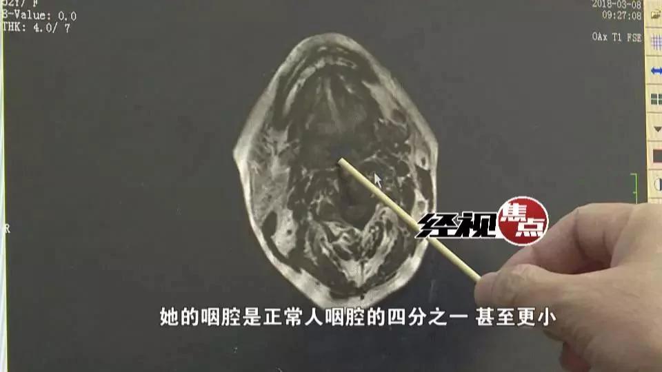 36岁女子睡觉尿床 原因竟是咽腔缩小睡觉打鼾