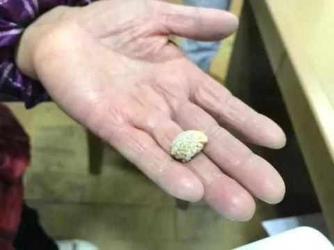 可怕!大妈剧烈咳嗽 竟喷出一块石头!