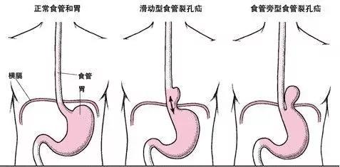 千万别再劝别人"多喝热水"了!你有可能是在害他