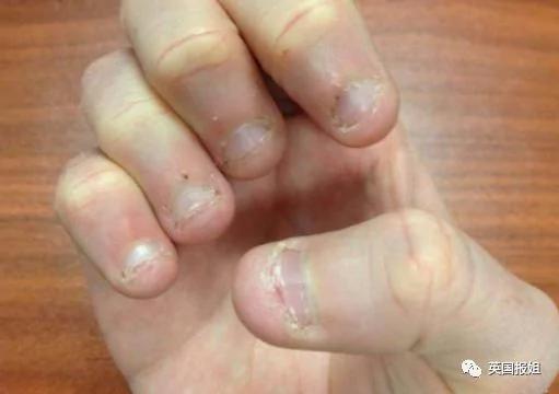 挤个痘痘险些送命?请一定要好好清理伤口…