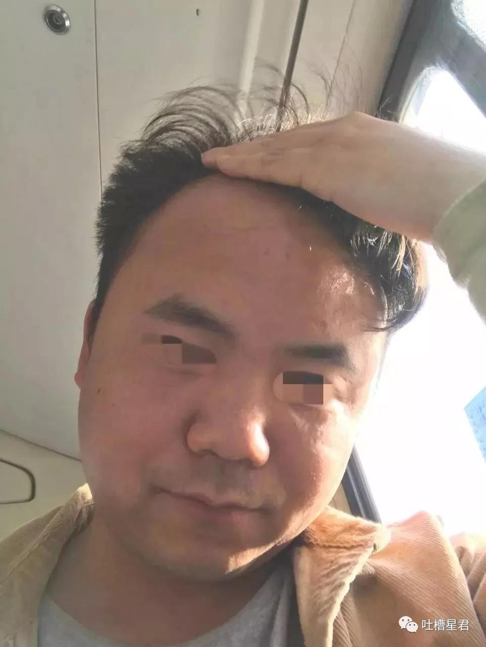 堪称毁容!网友纷纷晒4年前后对比照 劝大家别熬夜