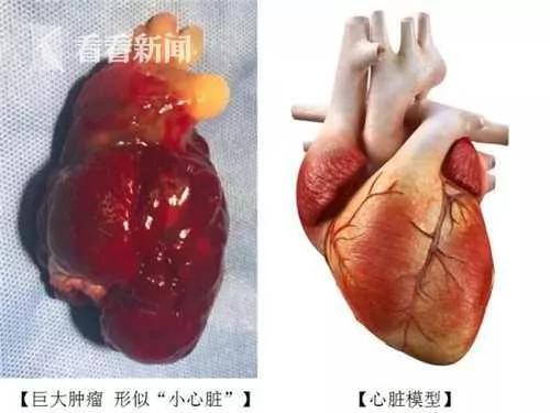 上海五旬男子心慌胸闷 左心房中惊现罕见肿瘤!