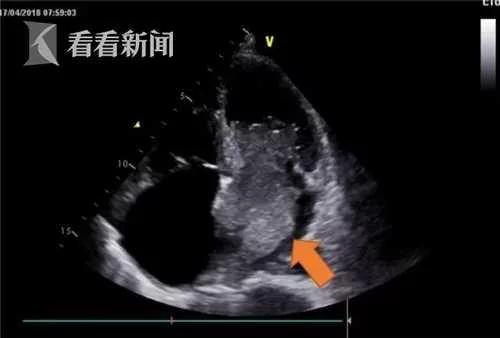 上海五旬男子心慌胸闷 左心房中惊现罕见肿瘤!