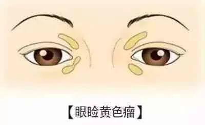 有种“丑”可能是心脏病征兆5种长相的人危险了