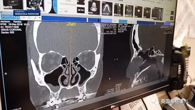 狂流鼻涕5年 最近她才发现这鼻涕竟是脑液…
