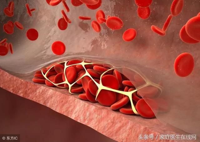 这种食物多吃一点 血栓多溶解一分