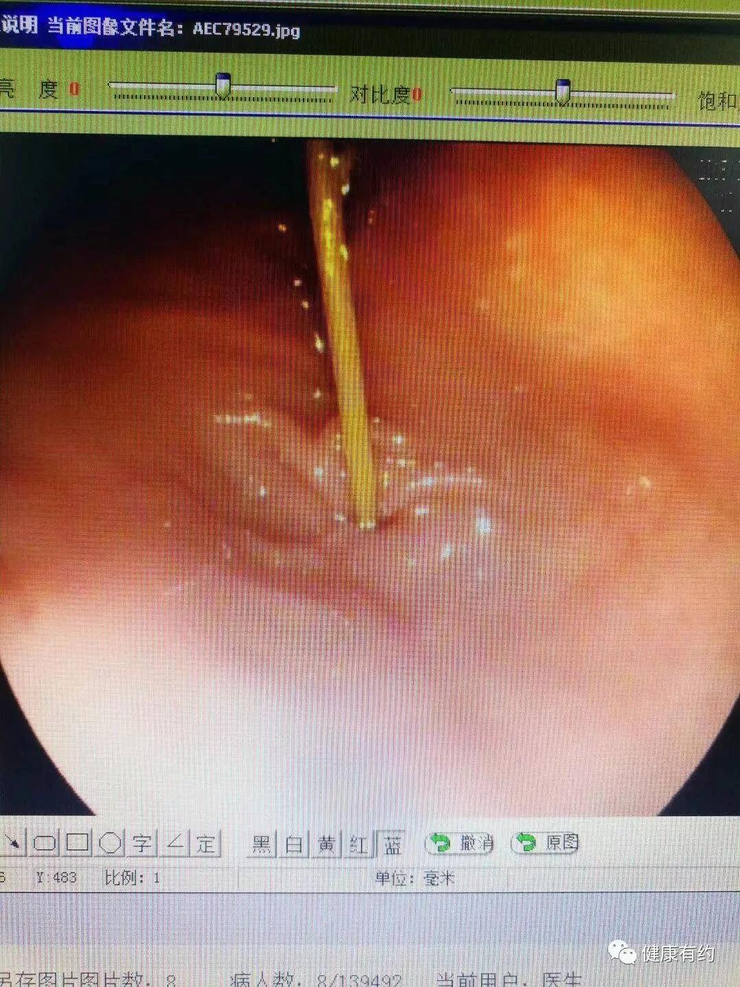 吃完饭都喜欢做这个动作 有人差点胃穿孔