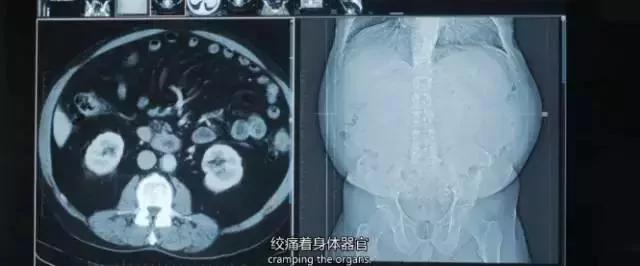 60天连续吃糖vs不吃糖 身体会发生怎样的变化?