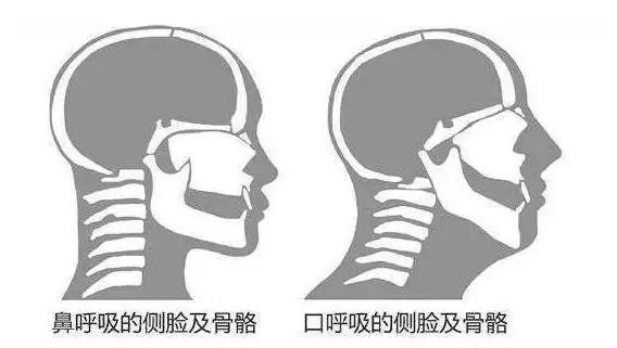 打呼噜会让你“变丑”!1分钟自查打鼾的你是否该就医