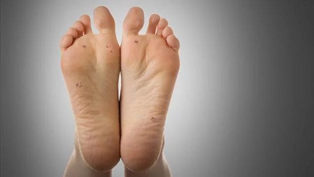 跑步、健走必看!常遇到的“脚丫十大病症”