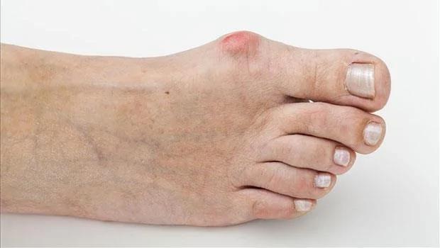 跑步、健走必看!常遇到的“脚丫十大病症”