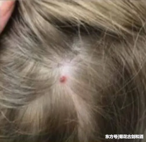 5岁女孩突然瘫痪原因成谜 直到妈妈在她的头发里发现了这!