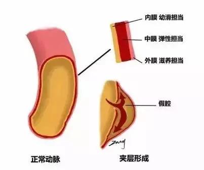 一种比急性心梗更可怕的胸痛!